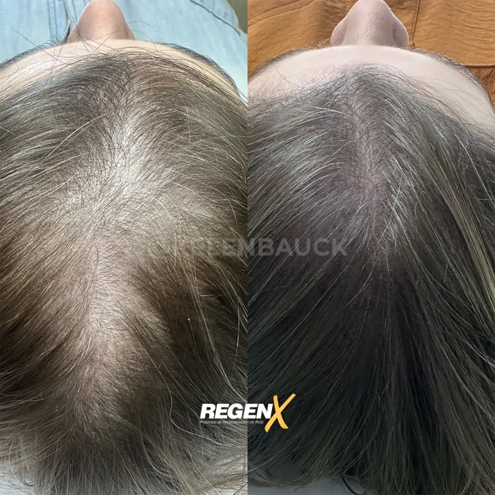 [4]-[REGENX]-[CHEVEUX]