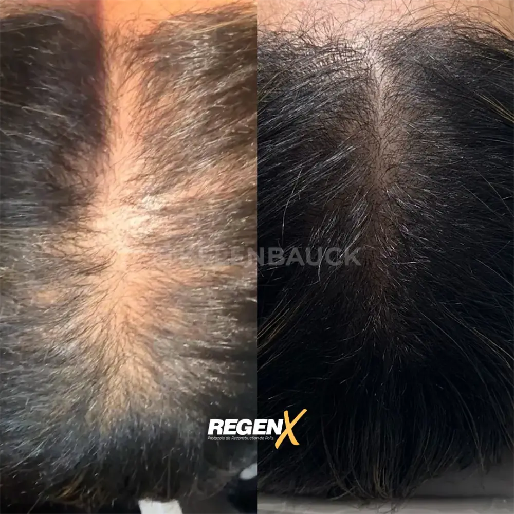 [5]-[REGENX]-[CHEVEUX]