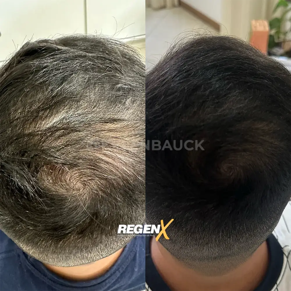 [8]-[REGENX]-[CHEVEUX]
