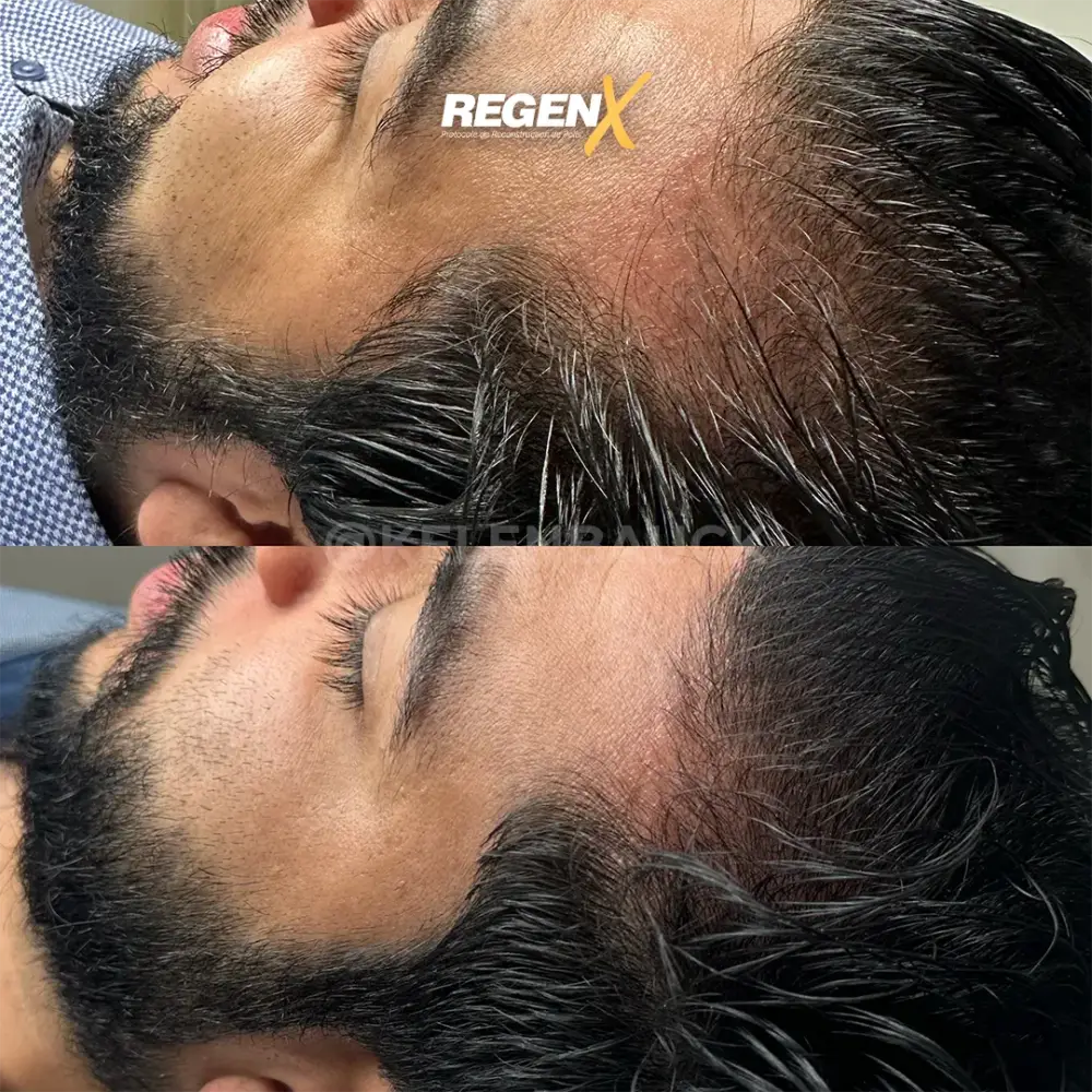 [10]-[REGENX]-[CHEVEUX]