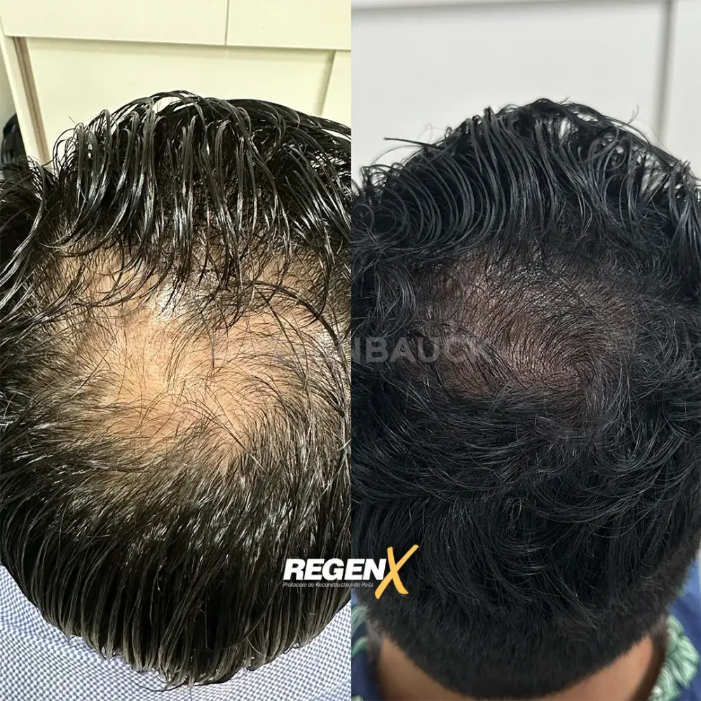 [11]-[REGENX]-[CHEVEUX]