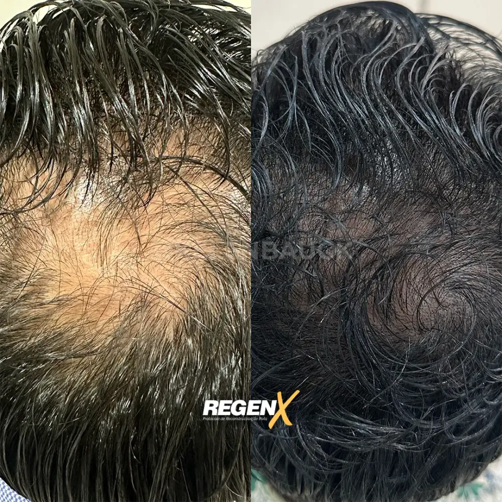 [12]-[REGENX]-[CHEVEUX]