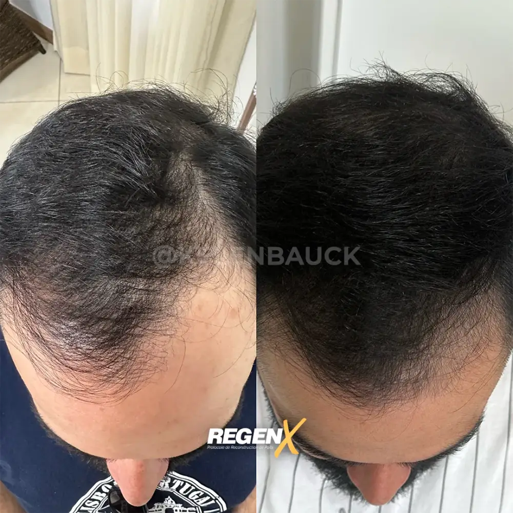 [13]-[REGENX]-[CHEVEUX]