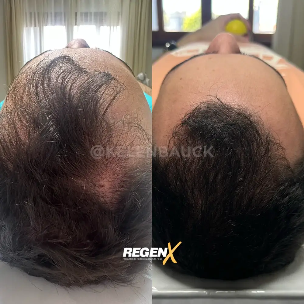 [14]-[REGENX]-[CHEVEUX]