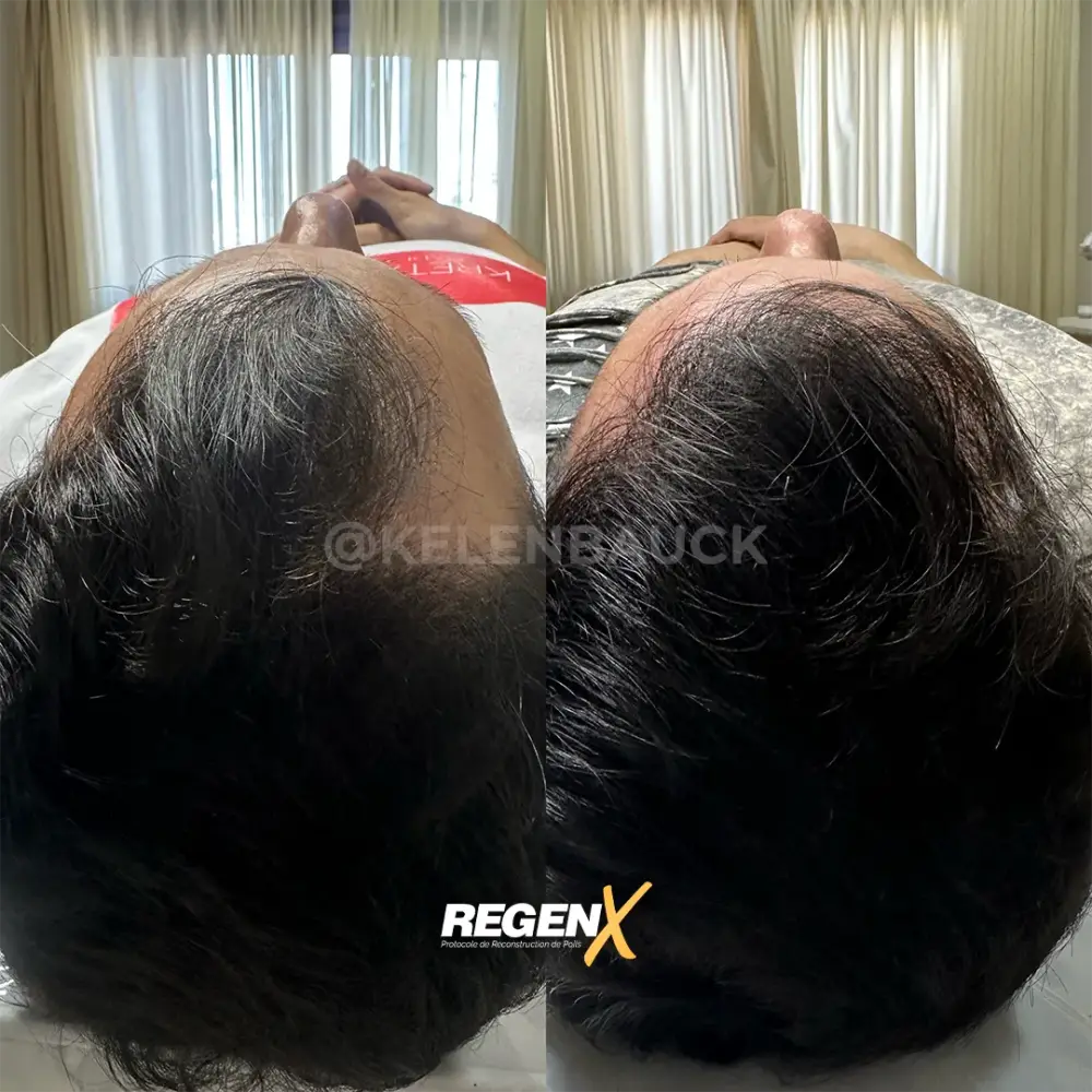 [18]-[REGENX]-[CHEVEUX]