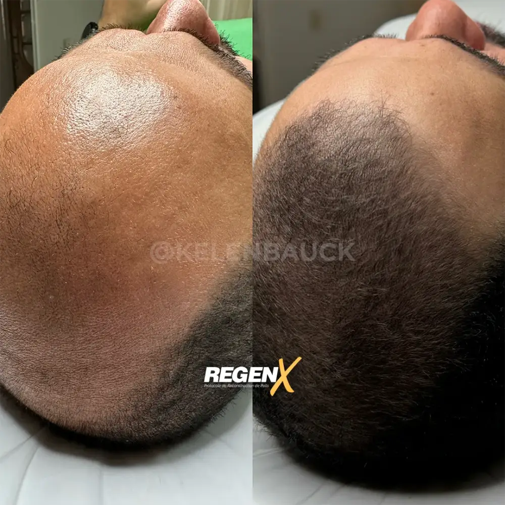 [19]-[REGENX]-[CHEVEUX]