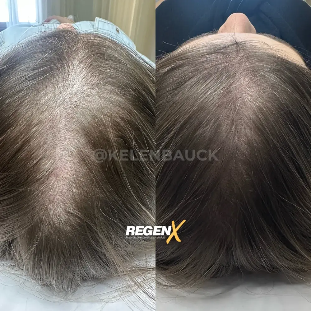 [20]-[REGENX]-[CHEVEUX]