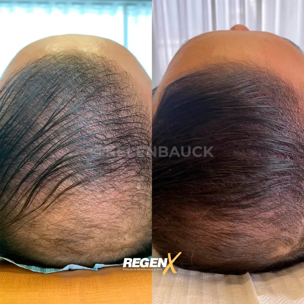 [22]-[REGENX]-[CHEVEUX]