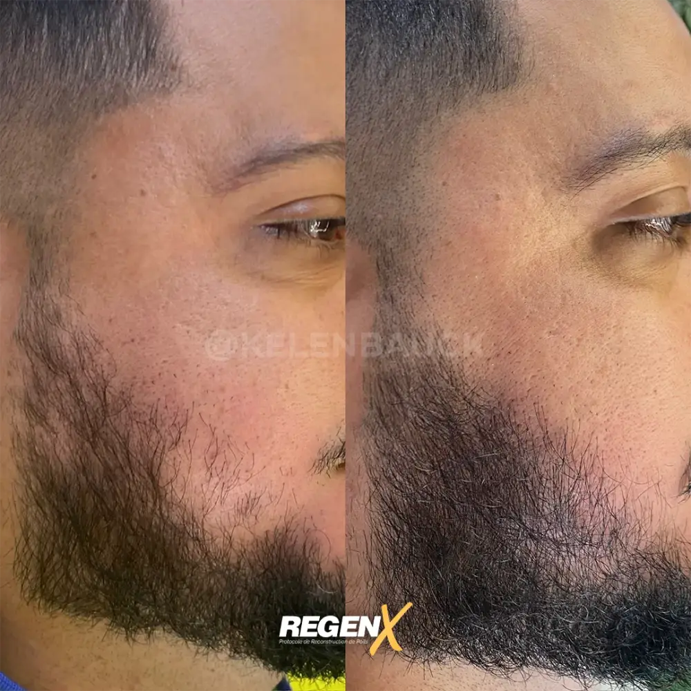 [2]-[REGENX]-[BARBE]
