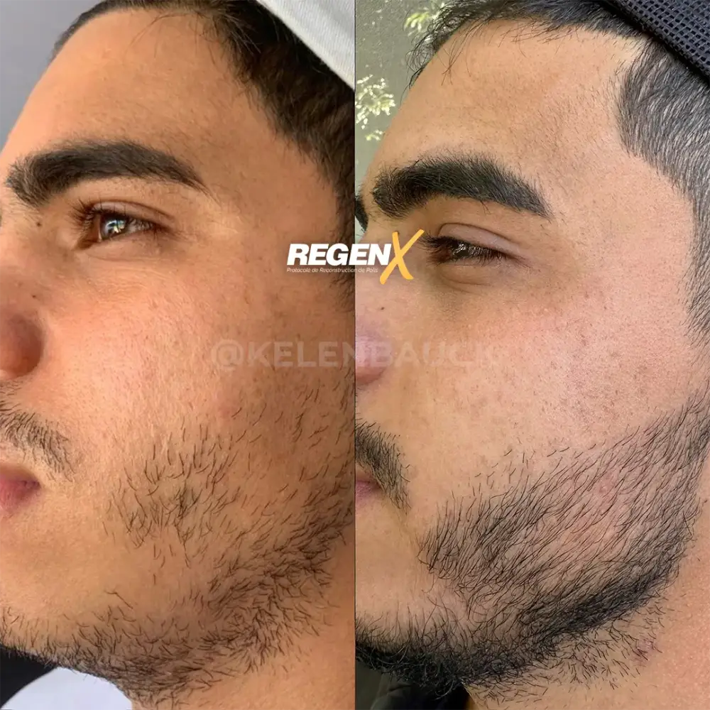 [3]-[REGENX]-[BARBE]